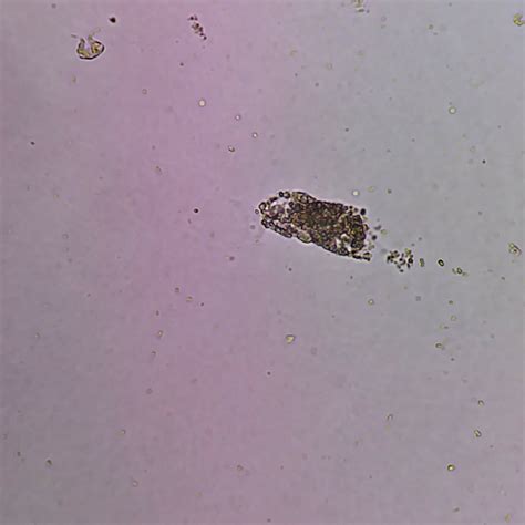 Urinary Casts: Identification & Significance