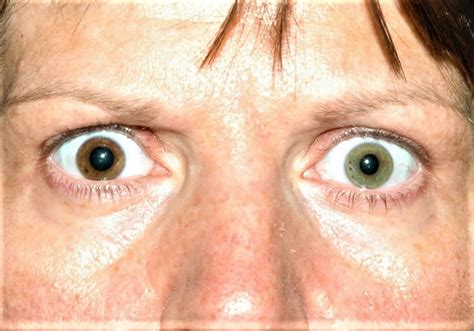 Heterochromia eyes in humans causes, how rare is heterochromia iridis?