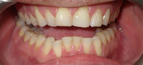 Bonding & Fillings | Grove Dental Associates