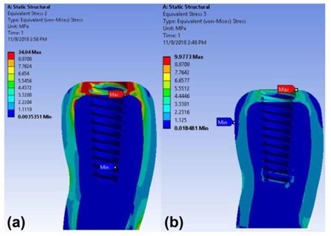 Finite Element Analysis of Dental Implants with Zirconia Crown ...