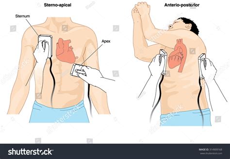 Image result for Synchronized Cardioversion Pad Placement