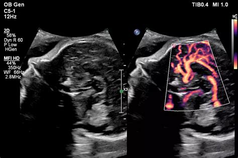 Fetal brain pericallosal artery with MFI HD using C5-1 transducer