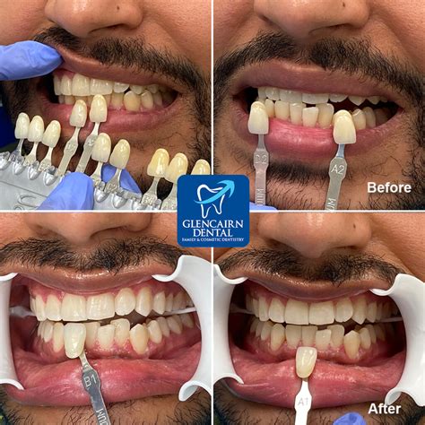 Teeth Whitening