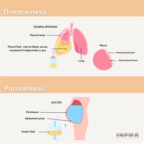 Thoracentesis and paracentesis – INFRA Healthcare