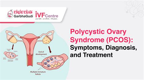 Polycystic Ovary Syndrome Diagram Polycystic Ovarian Syndrome (PCOS)