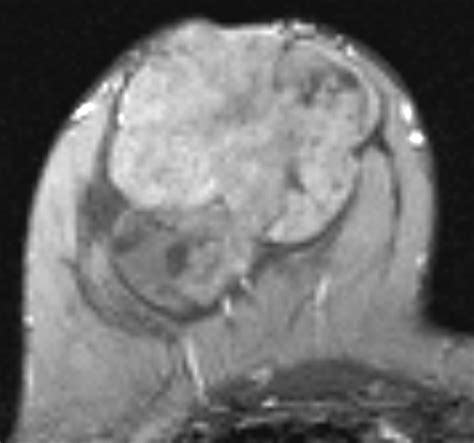 Differentiation of Phyllodes Breast Tumors from Fibroadenomas on MRI | AJR