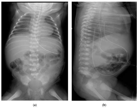 Caudal Regression Syndrome