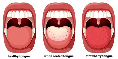 White tongue coating: causes & prevention - Oral Health Insights