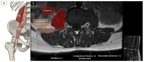 Pictorial Essay on Ultrasound and Magnetic Resonance Imaging of ...