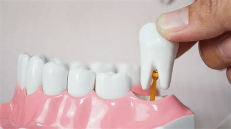 Things Needed for Tooth Extraction Recovery 的图像结果