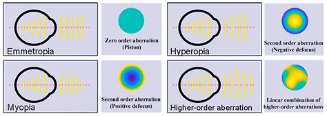 Advanced Optical Wavefront Technologies to Improve Patient Quality of ...