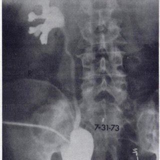 Image result for Distal Loopogram