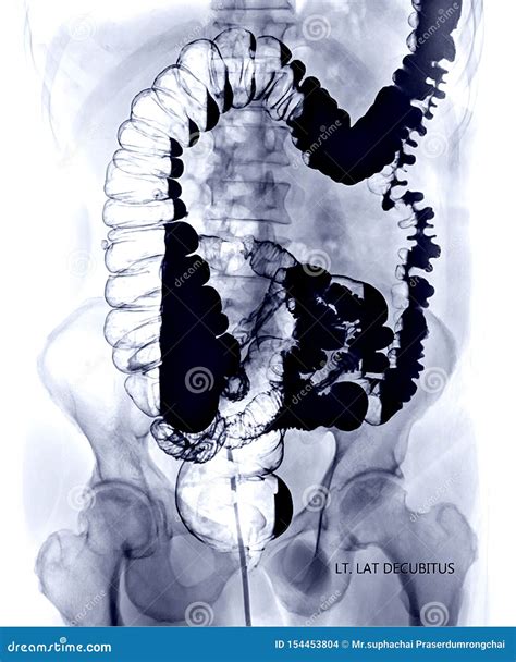 Barium Enema Image or BE Left Lateral Decubitus Stock Photo - Image of human, appendix: 154453804