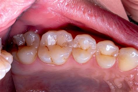 Tooth Decay Symptoms: From Early Warning Signs to Severe Stages