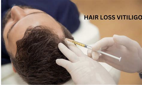 Mini punch grafts- reliable method of treatment for hairline vitiligo