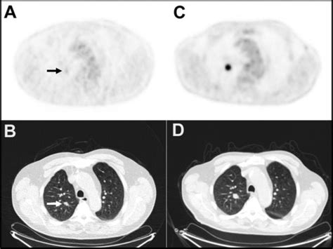 For Early-Stage Lung Cancer, a New Biomarker and Treatment Target? - NCI