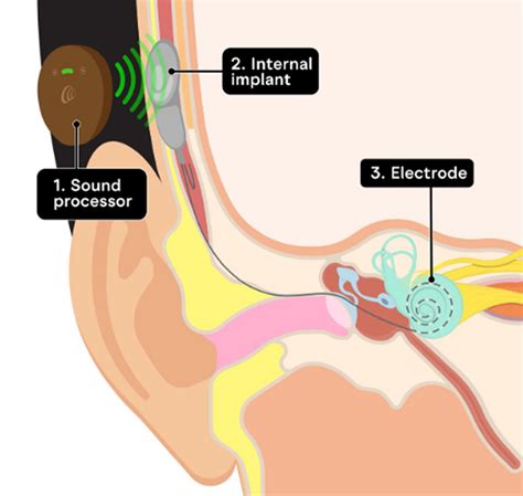 How Do Cochlear Implants Work