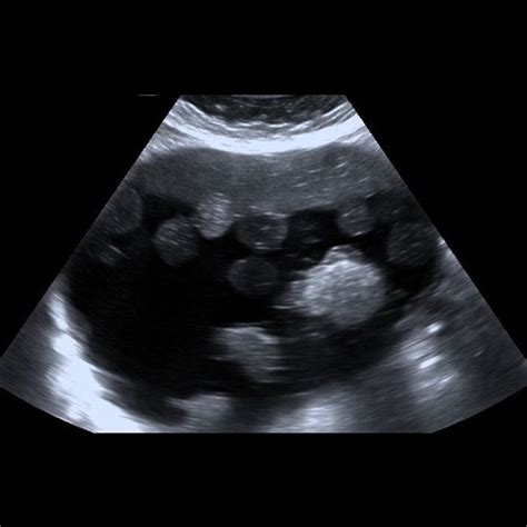 A Rare Presentation of Dual Ovarian Pathologies