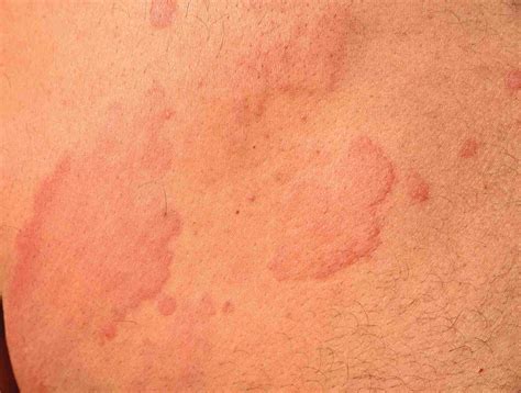 Gallery of Hives Pictures for Identifying Rashes