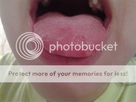 Red bumps on tongue w burning | BabyCenter