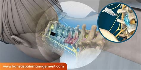 Medial Branch Block Anatomy