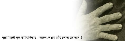 एक्रोमेगली रोग के लक्षण, कारण, इलाज, दवा, उपचार और परहेज | Acromegaly ...