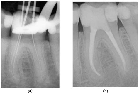 What Is An Example Of Endodontic Treatment at Sebastian Vosz blog