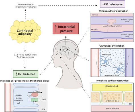 Idiopathic Intracranial Hypertension Pseudotumor Cerebri Paediatric