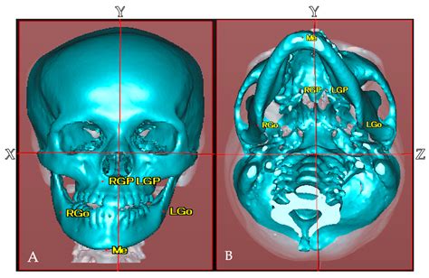 Cranial Vault Deformation and Its Association with Mandibular Deviation ...