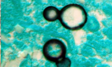 Lancet: Addressing Bacteria Alone Insufficient to Tackle Deadly ...