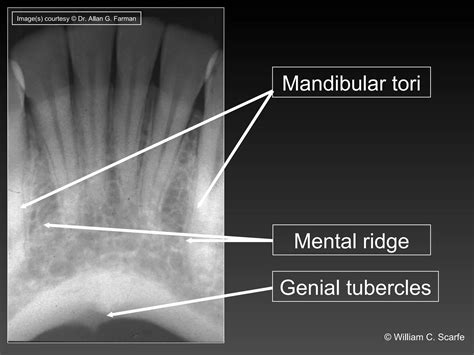 Dental Maxillary and Mandibular Anatomic Radiographic Landmarks.ppt