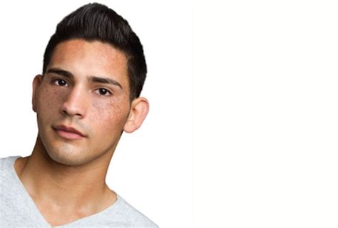 How To Treat Male Skin Pigmentation & Skin Darkening - Causes, Types ...