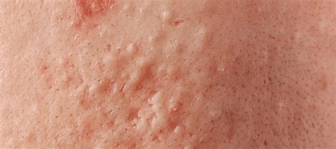 What to do After Accidentally Popping a Pimple? - The Pink Foundry