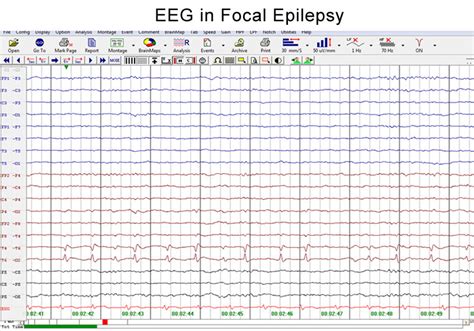 Child Neurologist | Pediatric Neurologist | Child Neurology | Epilepsy ...
