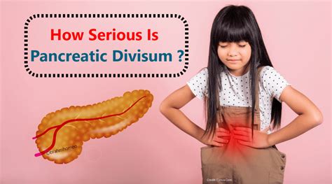 Pancreatitis | pancreas | pancreatitis divisum treatment | best ...