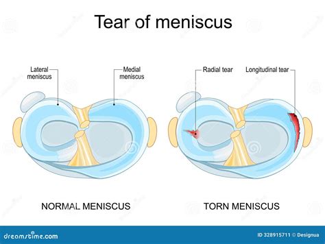 Meniscal Tear. Torn Meniscus Stock Vector - Illustration of sprain, injury: 328915711
