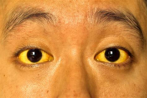 Jaundice: Causes, Symptoms, and Treatment Options