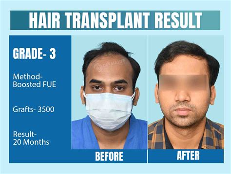 Hair Transplant Clinic in Delhi, India | Best Hair Transplant in Delhi