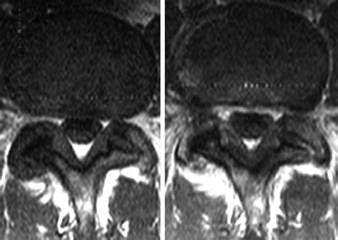 Ligamentum Flavum Hypertrophy Mri