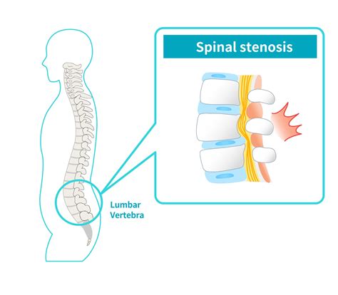 Spinal Stenosis - Lymington Chiropractic Clinic