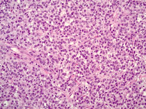 Pathology Outlines - Granulosa cell tumor-adult