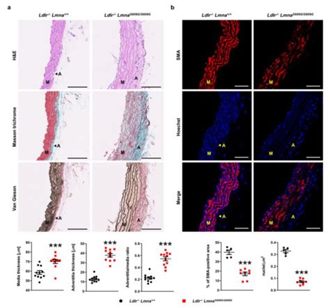 Premature Vascular Aging with Features of Plaque Vulnerability in an ...