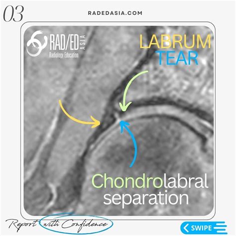 HIP LABRUM LABRAL TEAR MRI RADIOLOGY - Radiology Education Asia