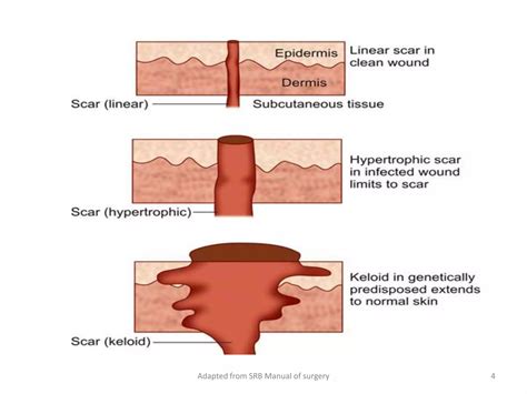 Discuss keloid and hypertrophic scars | PDF
