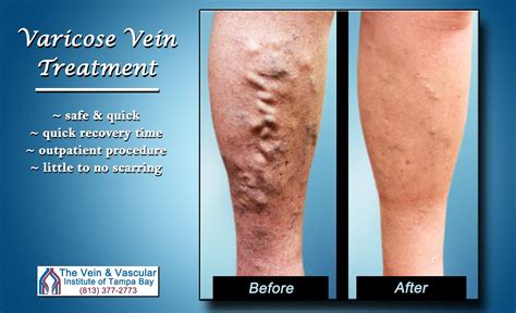 Varicose veins treatment tampa for safe and quick vein removal – Artofit