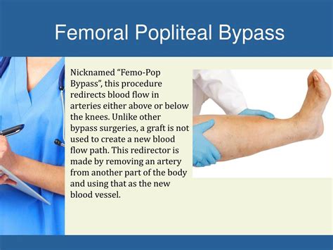 Femoral Popliteal Bypass