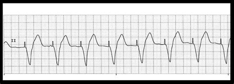 Basic Dysrhythmia Practice Test 的图像结果