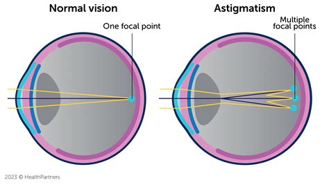 What Is Astigmatism And How Can It Be Treated Kugler Vision