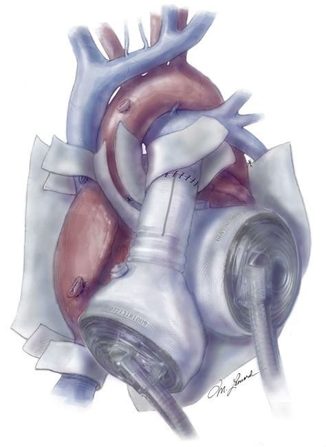 Total Artificial Heart Implantation: How I Teach It - The Annals of Thoracic Surgery