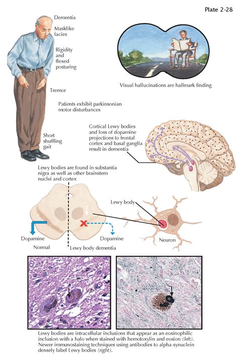 DEMENTIA WITH LEWY BODIES - pediagenosis